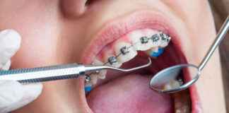 Diş Teli Fiyatları ile Geçmişe Kısa Bir Bakış Diş Teli Fiyatları Ne Kadar Oldu? Güncel Rehber